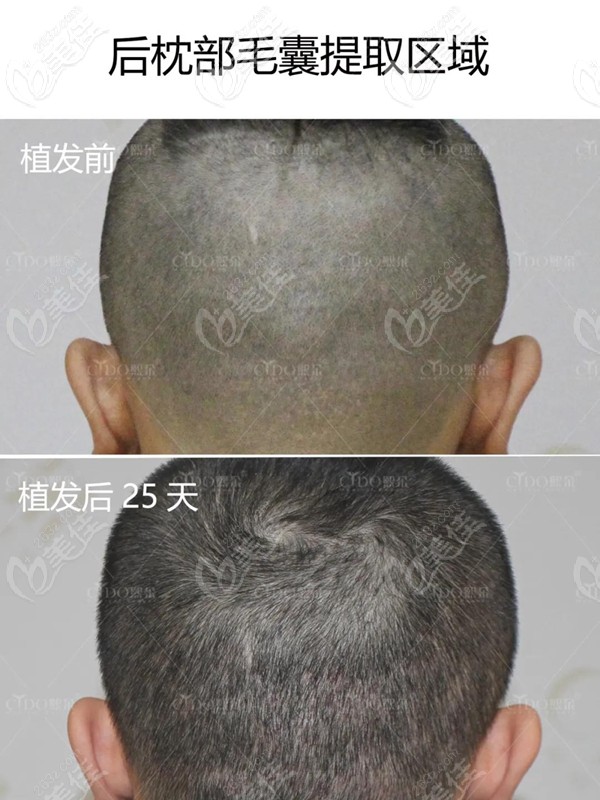 熙朵植發(fā)后后枕部恢復(fù)情況 熙朵植發(fā)后后枕部恢復(fù)情況