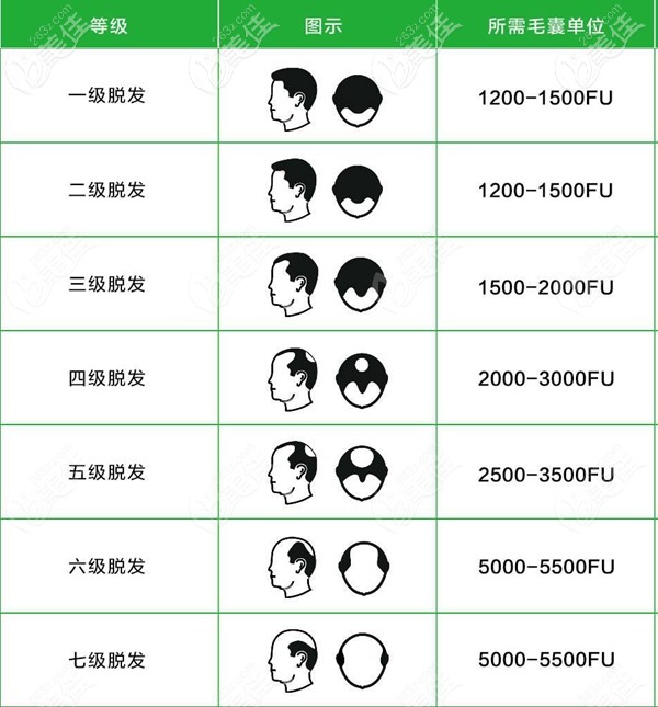 男士額角脫發(fā)種植毛囊數(shù)量圖 男士額角脫發(fā)種植毛囊數(shù)量圖