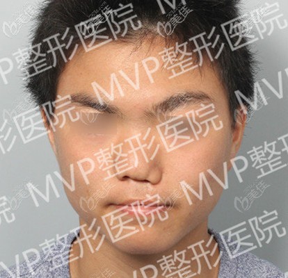 唇腭裂導(dǎo)致的鼻子塌陷 唇腭裂導(dǎo)致的鼻子塌陷