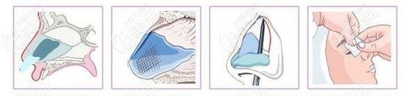 唇腭裂鼻子塌陷修復(fù)辦法 唇腭裂鼻子塌陷修復(fù)辦法