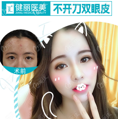 廣州健麗鐳射雙眼皮效果反饋,健麗鐳射定位雙眼皮技術(shù)果然靠譜