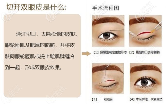 蕪湖名姝醫(yī)院姚福東醫(yī)生雙眼皮怎么做？
