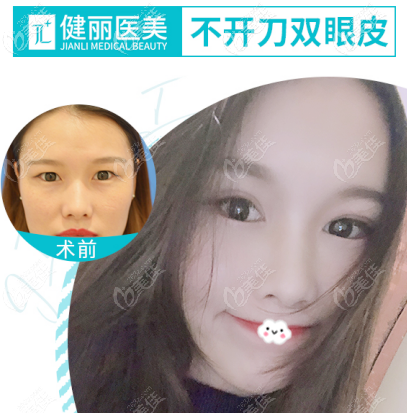 廣州健麗鐳射定位雙眼皮的技術(shù)到底靠譜嗎 廣州健麗鐳射定位雙眼皮的技術(shù)到底靠譜嗎