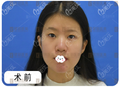 廣州健麗醫(yī)美做完鐳射定位雙眼皮親身經(jīng)歷 廣州健麗醫(yī)美做完鐳射定位雙眼皮親身經(jīng)歷