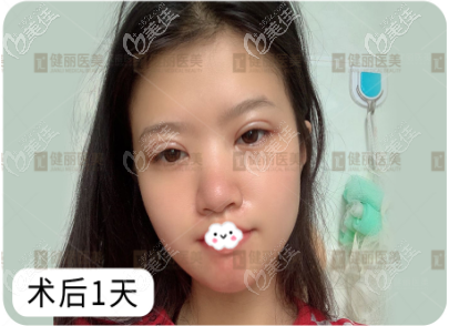 鐳射定位雙眼皮術(shù)后頭一個天恢復(fù)過程 鐳射定位雙眼皮術(shù)后頭一個天恢復(fù)過程