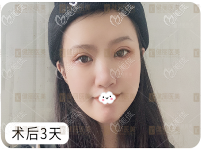 鐳射定位雙眼皮術(shù)后三天療效圖 鐳射定位雙眼皮術(shù)后三天療效圖