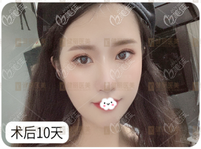 廣州健麗鐳射定位雙眼皮恢復(fù)過程圖片 廣州健麗醫(yī)美鐳射定位雙眼皮術(shù)后10天恢復(fù)過程反饋 廣州健麗鐳射定位雙眼皮恢復(fù)過程圖片 廣州健麗醫(yī)美鐳射定位雙眼皮術(shù)后10天恢復(fù)過程反饋