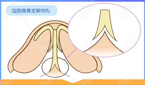 I型生態(tài)鼻支架術(shù)
