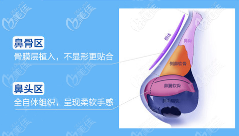 三段式仿生隆鼻術(shù)