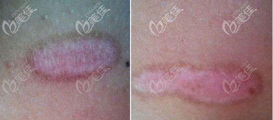 放療后的疤痕顏色圖 放療后的疤痕顏色圖