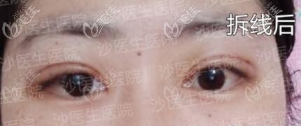 大連沙醫(yī)生整形醫(yī)院的CFS上瞼提肌矯正術真厲害，改善了我的重度上瞼下垂！