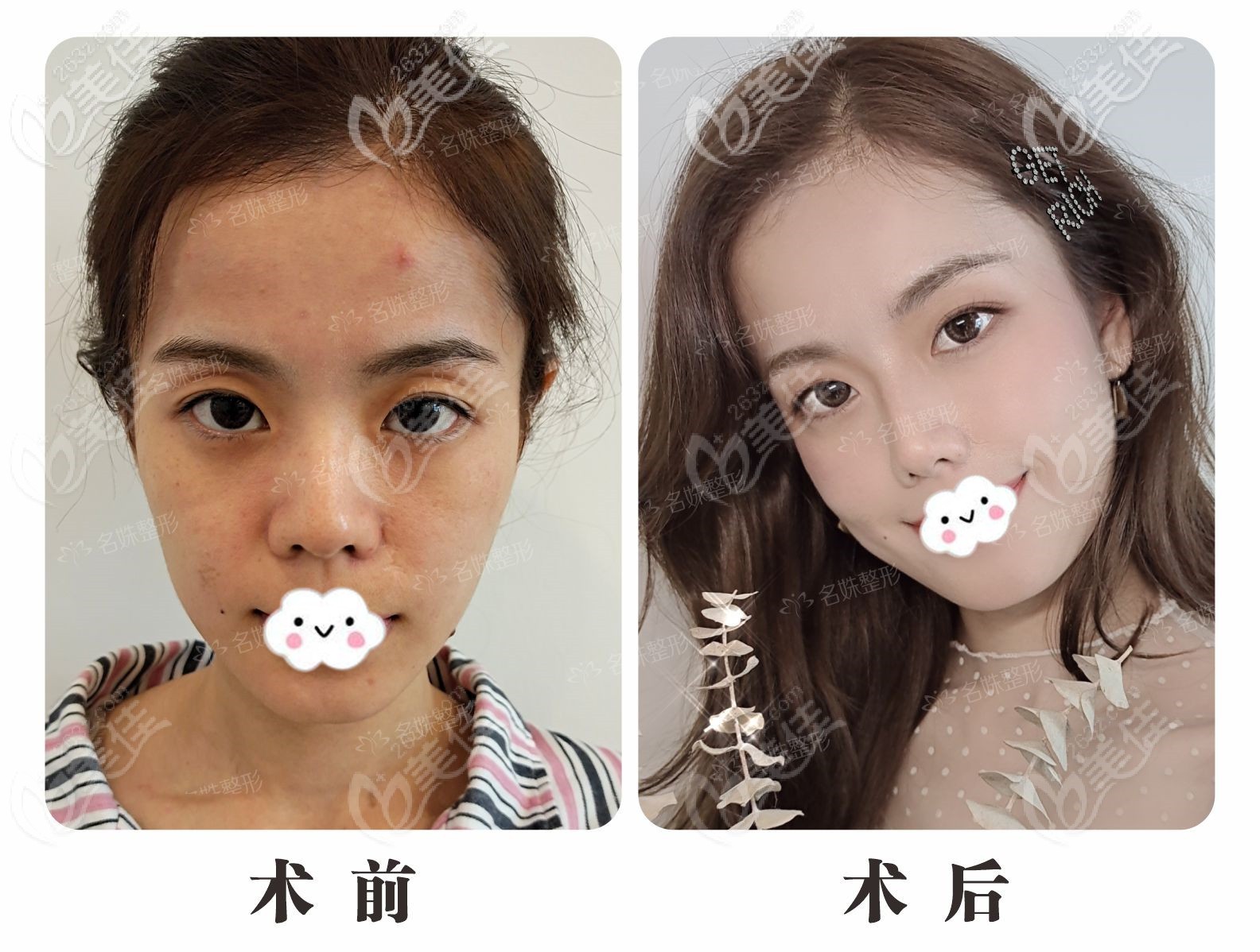 蕪湖名姝隆鼻手術(shù)怎么樣？李瑞主任鼻綜合案例