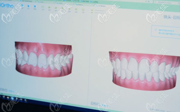 貝殼口腔引進(jìn)有口腔掃描儀