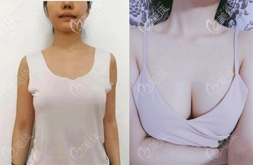 韓國普羅菲耳魔滴假體案例