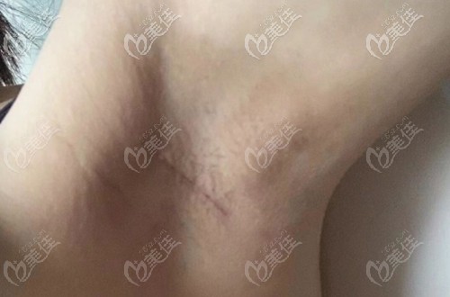 鄭在皓院長做的手術(shù)切口