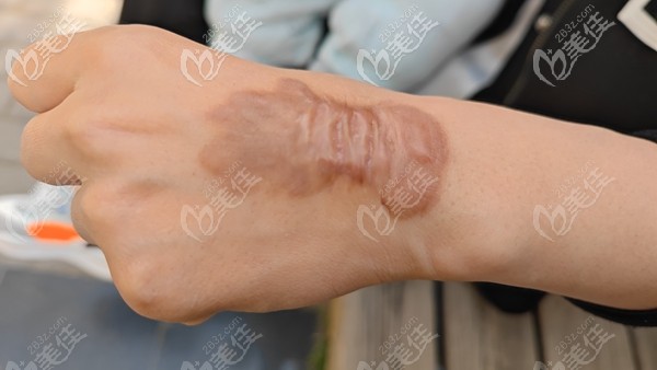 疤痕體質(zhì)手術(shù)后留下的疤痕疙瘩 疤痕體質(zhì)手術(shù)后留下的疤痕疙瘩