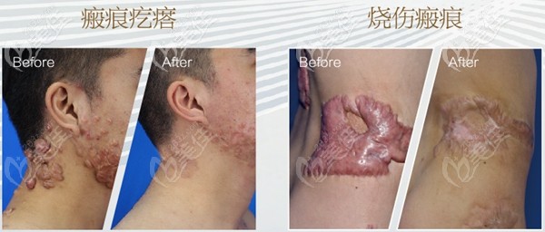 武漢正璞優(yōu)福通聯(lián)合其他激光治療疤痕疙瘩實(shí)例
