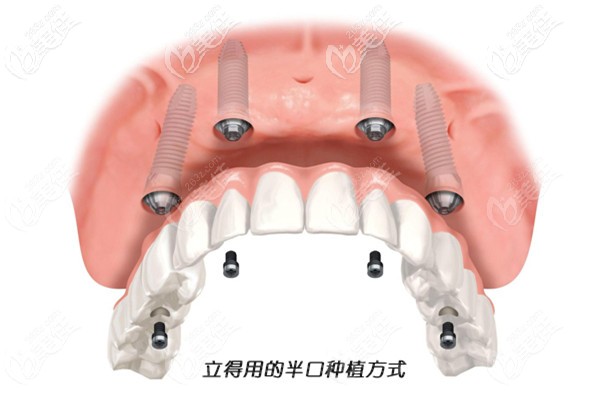 立得用種植牙的原理