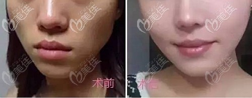 都在說南陽(yáng)維多利亞做面部脂肪填充有什么樣的好處，但我想問有弊端沒