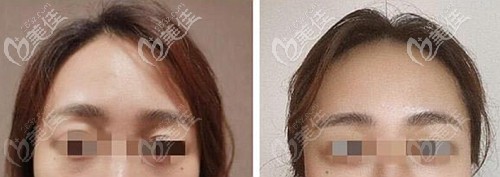 面部脂肪填充真人實例 面部脂肪填充真人實例