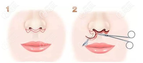 人中縮短手術(shù)過(guò)程