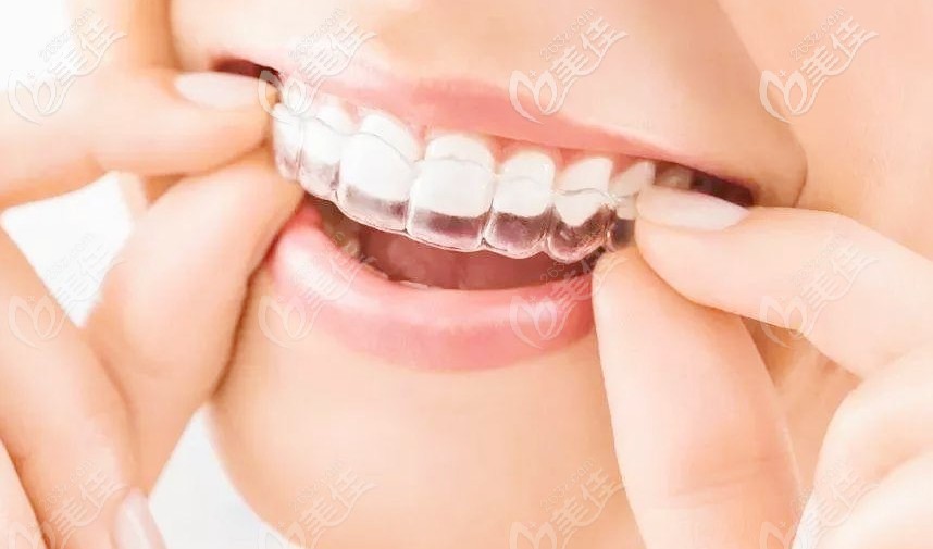 隱形牙套