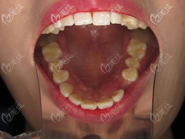 矯正之前的牙齒 矯正之前的牙齒