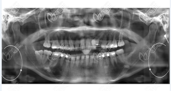 剛帶上牙套拍的牙片 剛帶上牙套拍的牙片