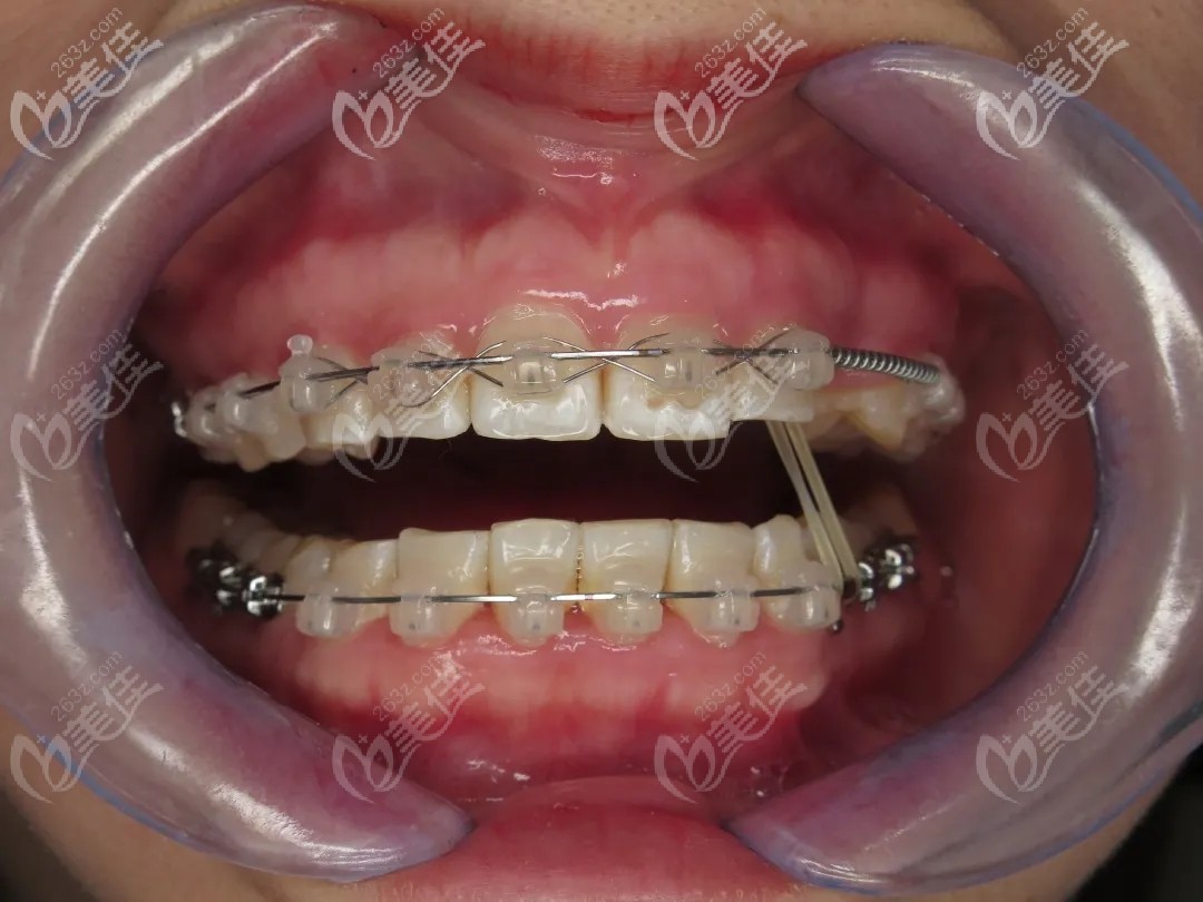 帶上牙套1年后 帶上牙套1年后