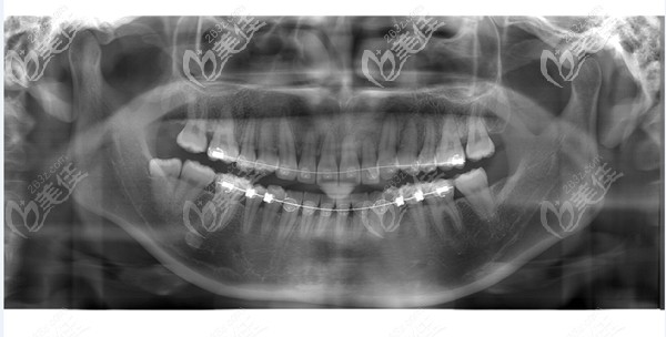 閨蜜20多歲在鄭州金水區(qū)戴陶瓷半隱形牙套矯正成年乳牙滯留,效果絕了