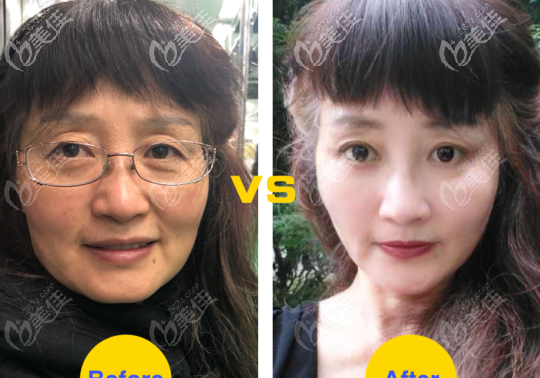 上眼瞼松弛＋眼袋手術(shù)效果圖