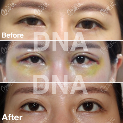 金沅碩眼綜合效果圖 金沅碩眼綜合效果圖