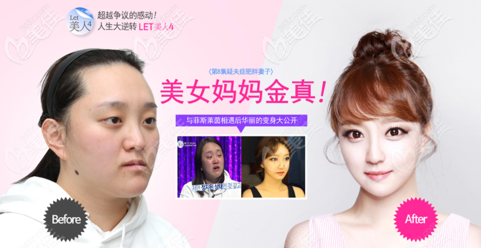 韓國(guó)雙鄂手術(shù)好的醫(yī)院-韓國(guó)菲斯萊茵整形醫(yī)院 韓國(guó)雙鄂手術(shù)好的醫(yī)院-韓國(guó)菲斯萊茵整形醫(yī)院