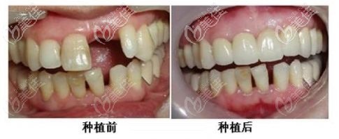 種植牙前后對(duì)比照