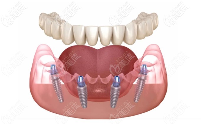 All-on-N技術(shù)——4~6顆修復(fù)半口缺牙