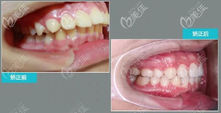 骨性II類上頜前突+下頜后縮的牙齒矯正案例,戴的是金屬自鎖牙套