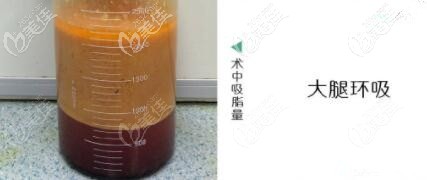 大腿環(huán)吸抽出的脂肪 大腿環(huán)吸抽出的脂肪