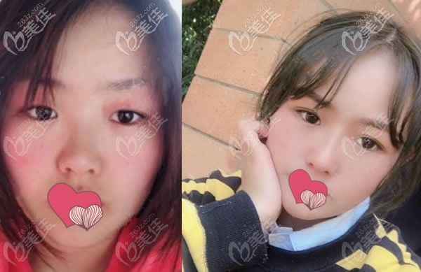 楊琉舒做的埋線雙眼皮術(shù)前后對比照片