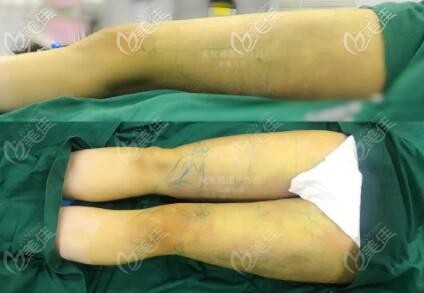 大腿環(huán)吸術(shù)后即刻效果照 大腿環(huán)吸術(shù)后即刻效果照