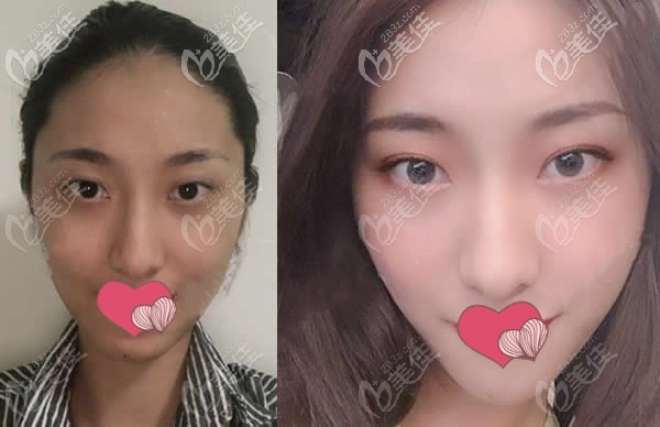 楊琉舒切開雙眼皮術(shù)前和術(shù)后1個(gè)月對比圖片