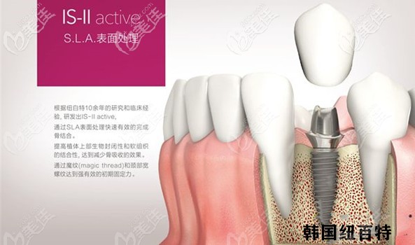 紐百特種植牙特點(diǎn)