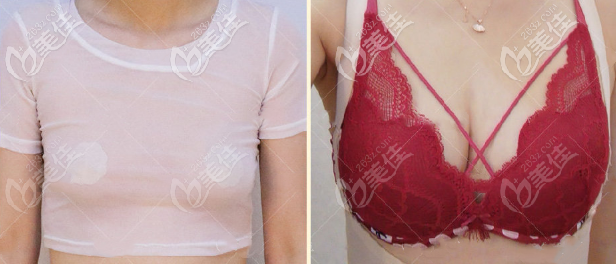 層級活性自體脂肪豐胸300cc效果圖