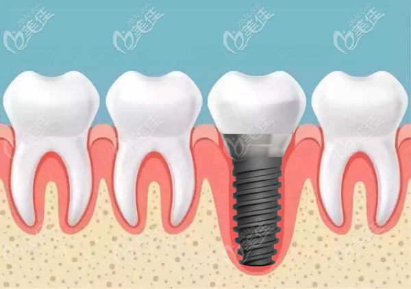?？怂狗N植體的美學即刻種植系統(tǒng)