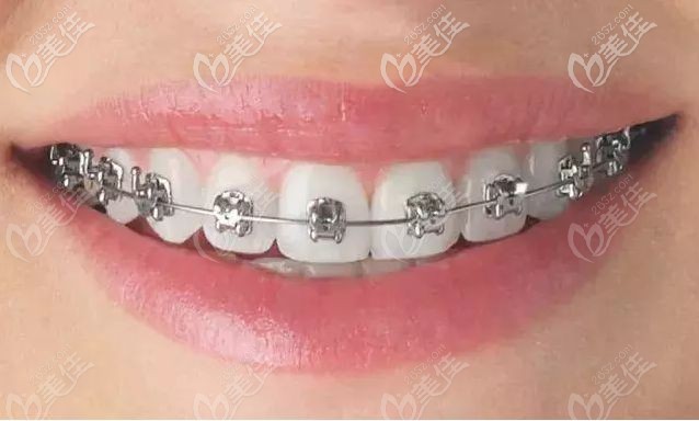 自鎖托槽矯治器 自鎖托槽矯治器