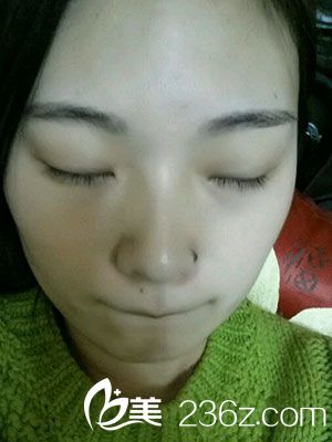 埋線雙眼皮微整形