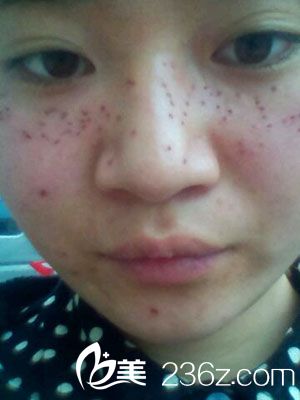 激光去雀斑，臉上好多斑跟了好多年怎么辦？