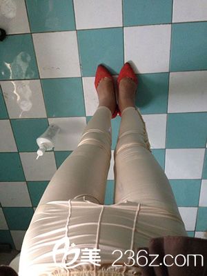 激光溶脂瘦大腿