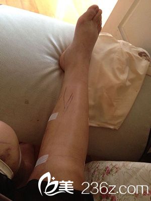 激光溶脂瘦大腿