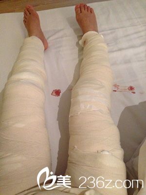 激光溶脂瘦大腿