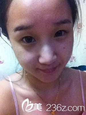 做部分切開法雙眼皮之前